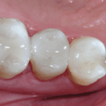 Tooth colored (composite) fillings